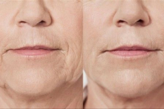GLOW PEEL RENEWLIFT