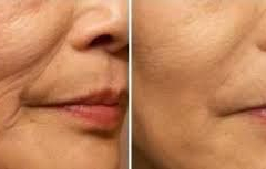 GLOW PEEL RENEWCOLLAGEN