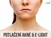 potlačení akné s ošetřením E-LIGHT